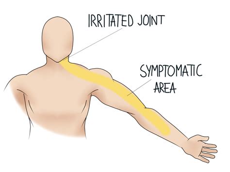 Referred Pain - Wiltshire Osteopathy