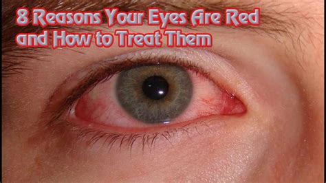 8 Reasons Why Your Eyes are Red – and How to Treat Them