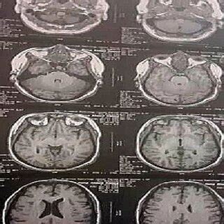 Brain MRI Showing Partial Empty Sella Features, with Enhanced Fluid... | Download Scientific Diagram