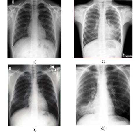 Normal Lung Vs Pneumonia Chest X Ray | Hot Sex Picture