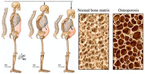 Osteoporosis - Causes, Risk Factors & Treatment, Symptoms, Medications