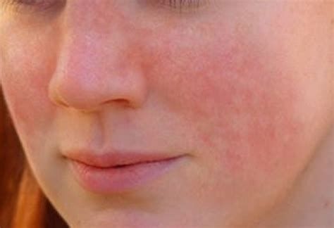 Lupus Rash - Pictures, Symptoms, Causes, Treatment - (2018 - Updated)