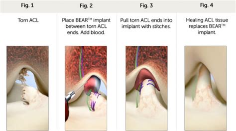 University Orthopedics adopts less invasive BEAR surgery for ACL repair