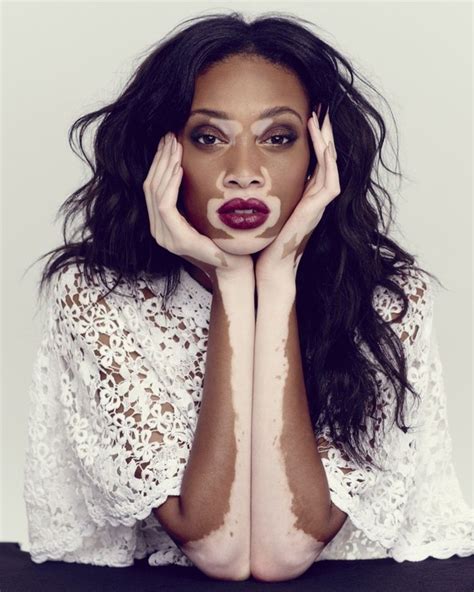 Día Mundial del Vitiligo: qué es y cuáles famosos aprendieron a vivir con la enfermedad