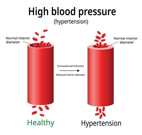 High Blood Pressure (Hypertension) Symptoms & Treatment | Dr Raghu