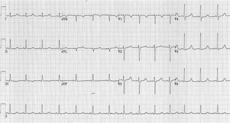 Hypocalcaemia ECG changes • LITFL • ECG Library