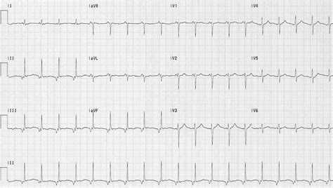 Accelerated Junctional Rhythm (AJR) • LITFL • ECG Library Diagnosis