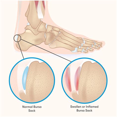 Retrocalcaneal Bursitis: Causes, Symptoms & Treatment