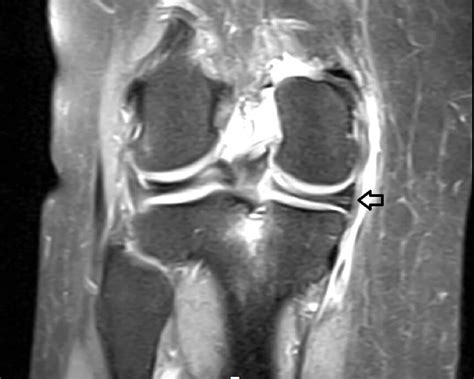 OrthoDx: Meniscal Root Tear - Clinical Advisor