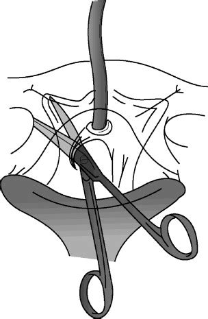 Pubovaginal Fascial Sling for the Treatment of all Types of Stress Urinary Incontinence ...