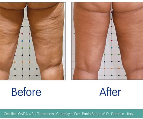 Effectiveness of microwaves in the treatment of cellulite: a ...