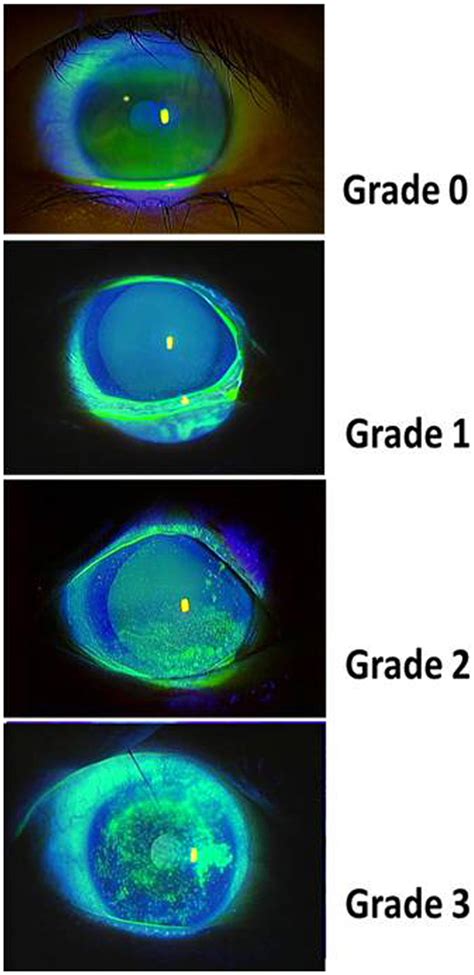 Corneal Staining Grading