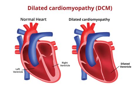 Dilated Cardiomyopathy (DCMP) - Dr. Gaurav Agrawal