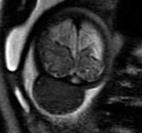 Prenatal imaging findings in rapidly involuting congenital hemangioma of the skull - Elia - 2008 ...