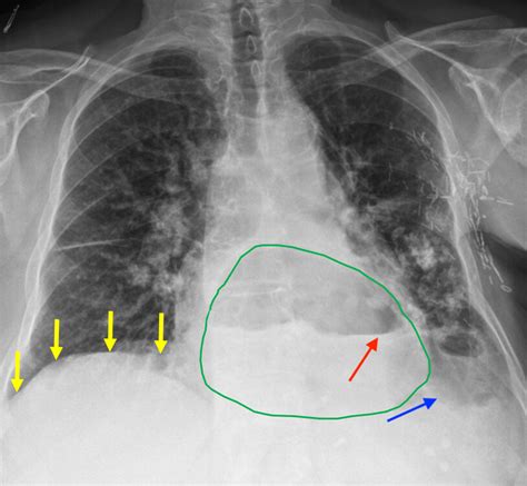 Paraesophageal Hernia X Ray