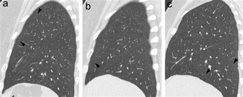 Incomplete and accessory fissures of the lung evaluated by high-resolution computed tomography ...