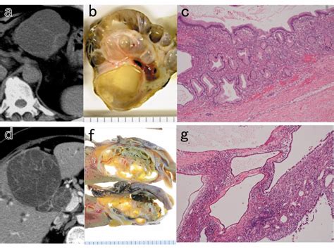 Mucinous Cystic Neoplasms Lined by Abundant Mucinous Epithelium Frequently Involve KRAS ...