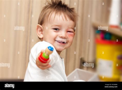 Bee sting child hi-res stock photography and images - Alamy