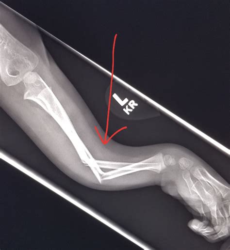 #Forearm #xray: angulated fractures in s child who fell out of a tree ...