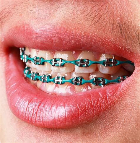 Pain during orthodontic treatment: non-pharmacological interventions ...