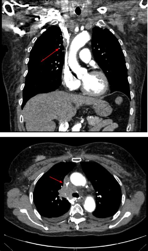 -CT-coronal view and axial views demonstrating SVC compression by the... | Download Scientific ...