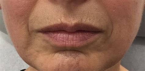 Juvederm Lips Before And After 1/2 Syringe / Lips : The results can create a subtle lift ...