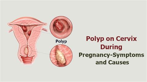 Polyp on Cervix During Pregnancy- Symptoms and Causes