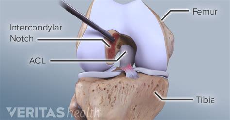 ACL Surgical Repair