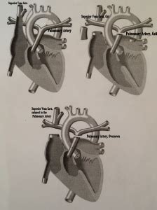 What is a Glenn Procedure? – Beach Bunk Diaries