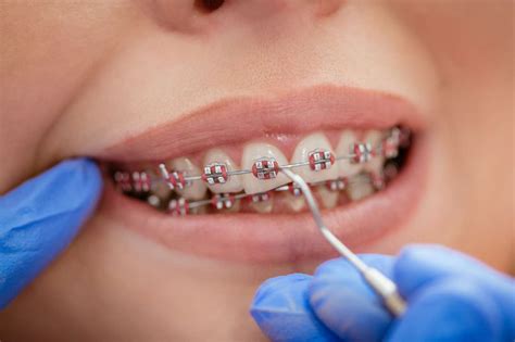 How to Remove Stains From Braces? [Detailed Guide]