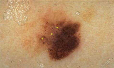 Staging of melanoma: The American Joint Committee on Cancer (AJCC) TNM ...