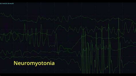 Neuromyotonia - YouTube