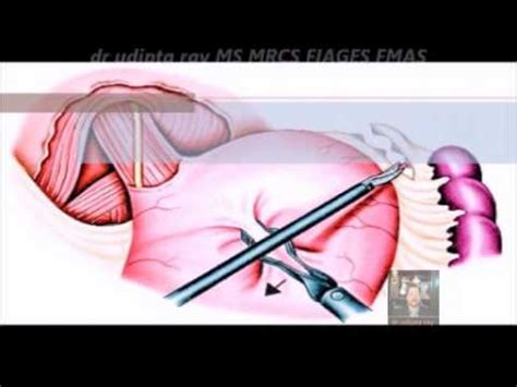 HELLER'S CARDIOMYOTOMY - YouTube