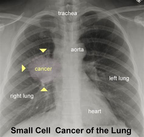 Xrays and CT Scans of Lung Cancer