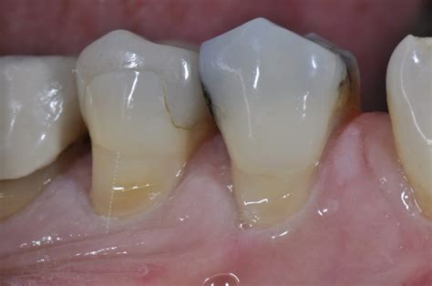 Cervical Abrasion | Composite Resin Restorations