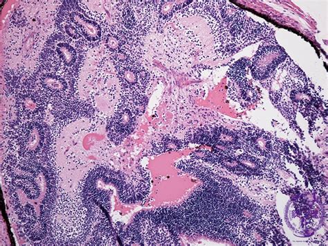 15.Female genital organs (9) Immature teratoma|Pathology Core Pictures