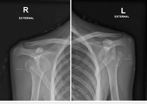 Bilateral shoulder x-rays showing anterior shoulder dislocation with ...