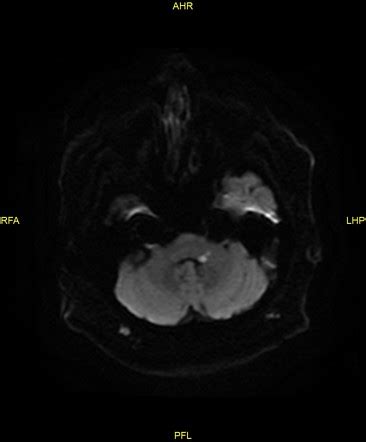 Lateral Pontine Syndrome Mri