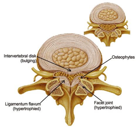 Spinal Stenosis Treatment Palm Beach County - Dr. Matthew Hepler