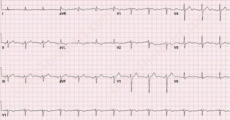 Atrial Arrhythmias ECG 23 | Learn the Heart