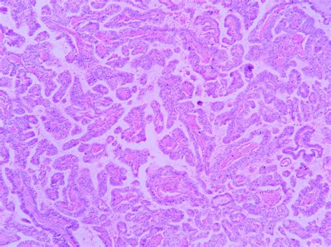 Papillary carcinoma – Thyroid – Histopathology.guru