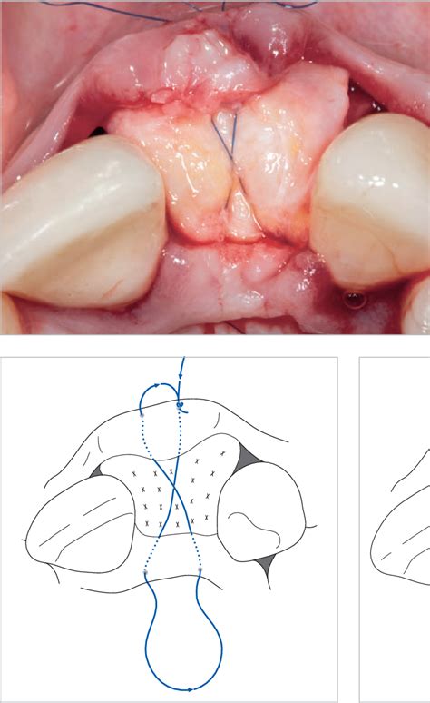 Figure 5 from Wound closure and wound healing. Suture techniques in contemporary periodontal and ...