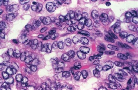 Papillary adenocarcinoma with optically clear nuclei (''Orphan Annie ...