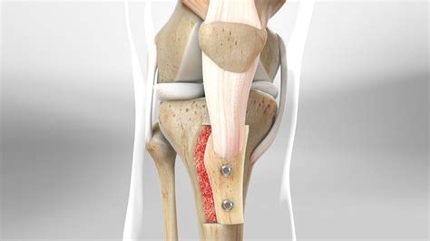 Best Tibial Tubercle Osteotomy | Femoral Derotational Transfer Surgery - Kneecares