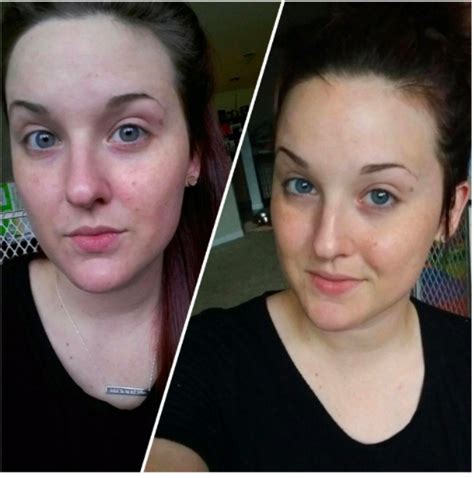 27 Skincare Products With Before And After Photos That'll Blow Your ...