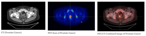 PET Scanning For Prostate Cancer | PET Imaging Institute