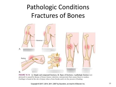 fractures Diagram | Quizlet