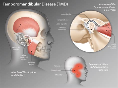 Time to Chew on Temporomandibular Disease | HealthPlexus.net