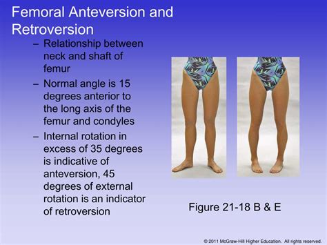 Femoral Anteversion And Retroversion