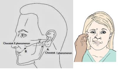 Signs of Hypocalcemia | Medicine Specifics